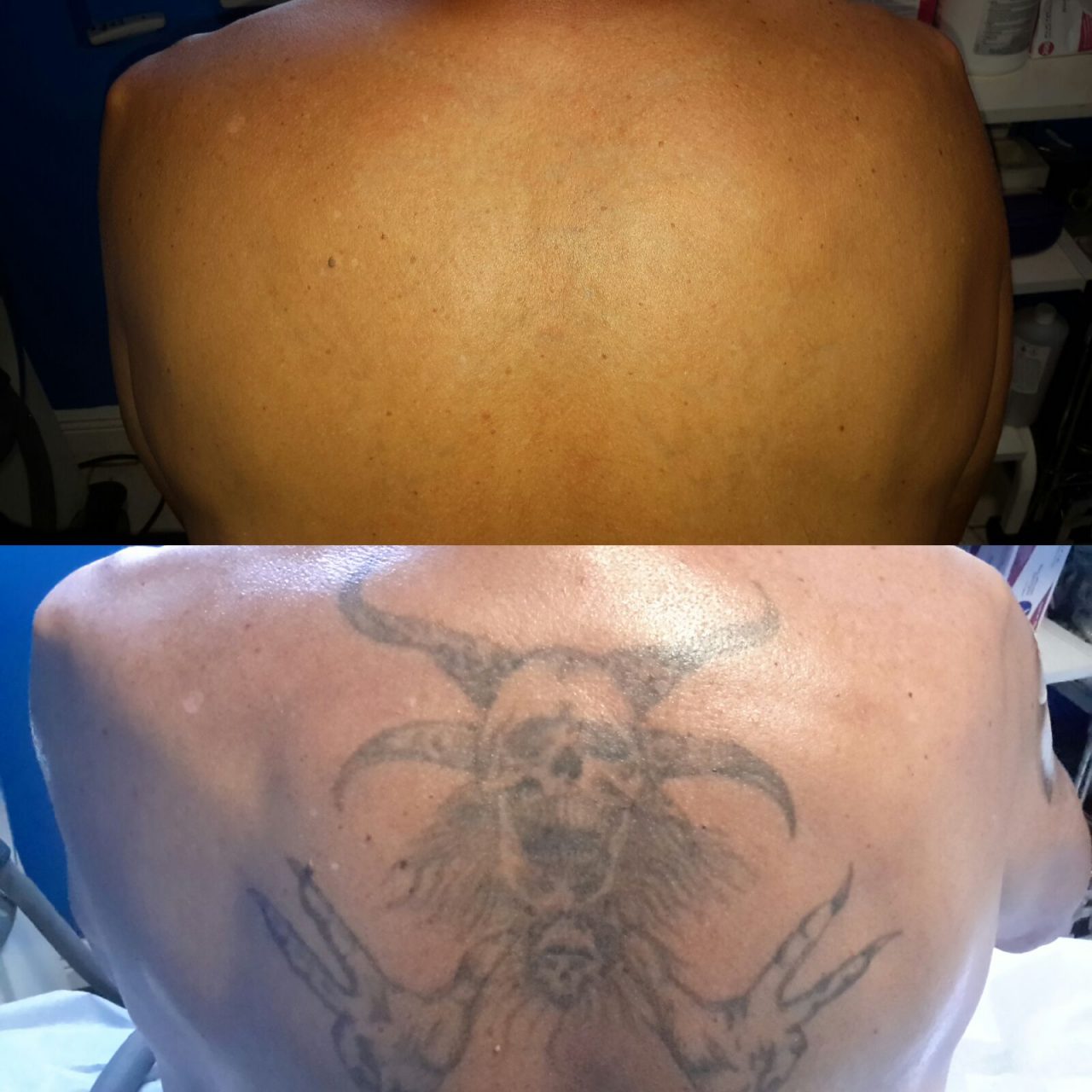 Tattoo Removal Near Me