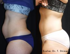 belly fat contouring nonsurgical winter park