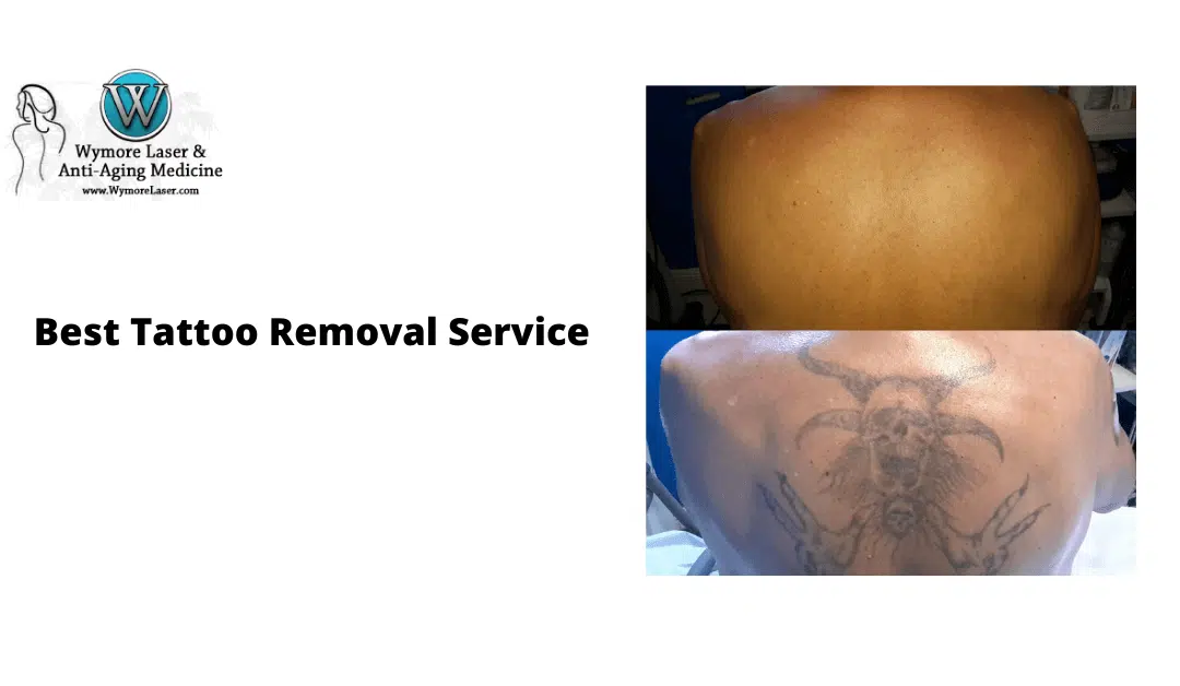 Call Us For The Best Tattoo Removal Service In Orlando!