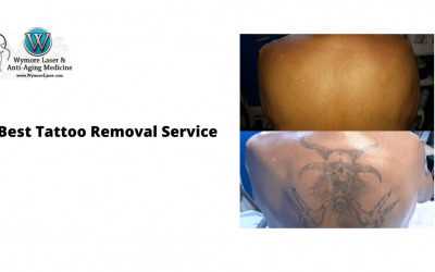 Call Us For The Best Tattoo Removal Service In Orlando!