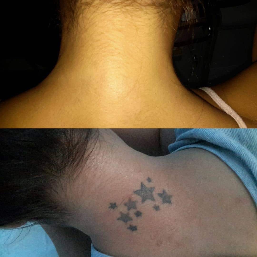 ReversaTatt Tattoo Removal