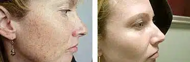 facial-before-after facial-before-after