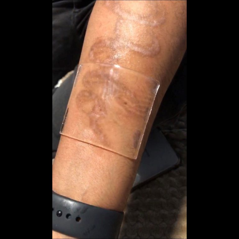 laser tattoo removal healing process