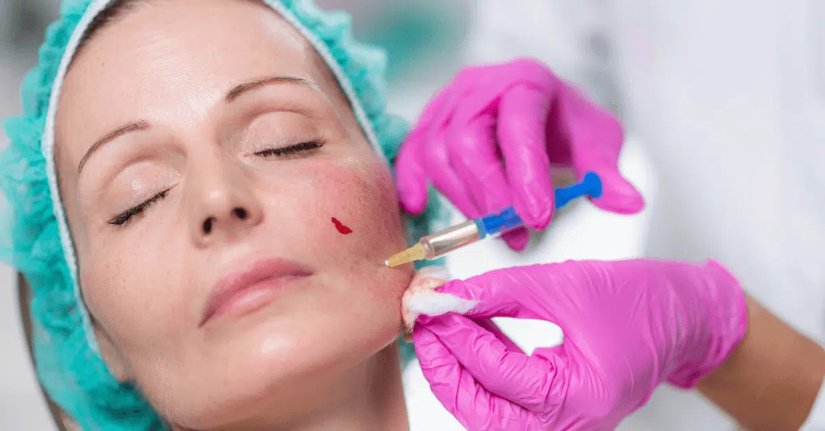 face fillers near Orlando face fillers near Orlando