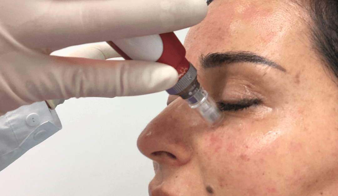 microneedling face treatments near Orlando