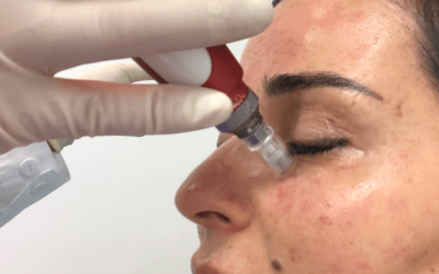 Microneedling Is One of the Best Face Treatments