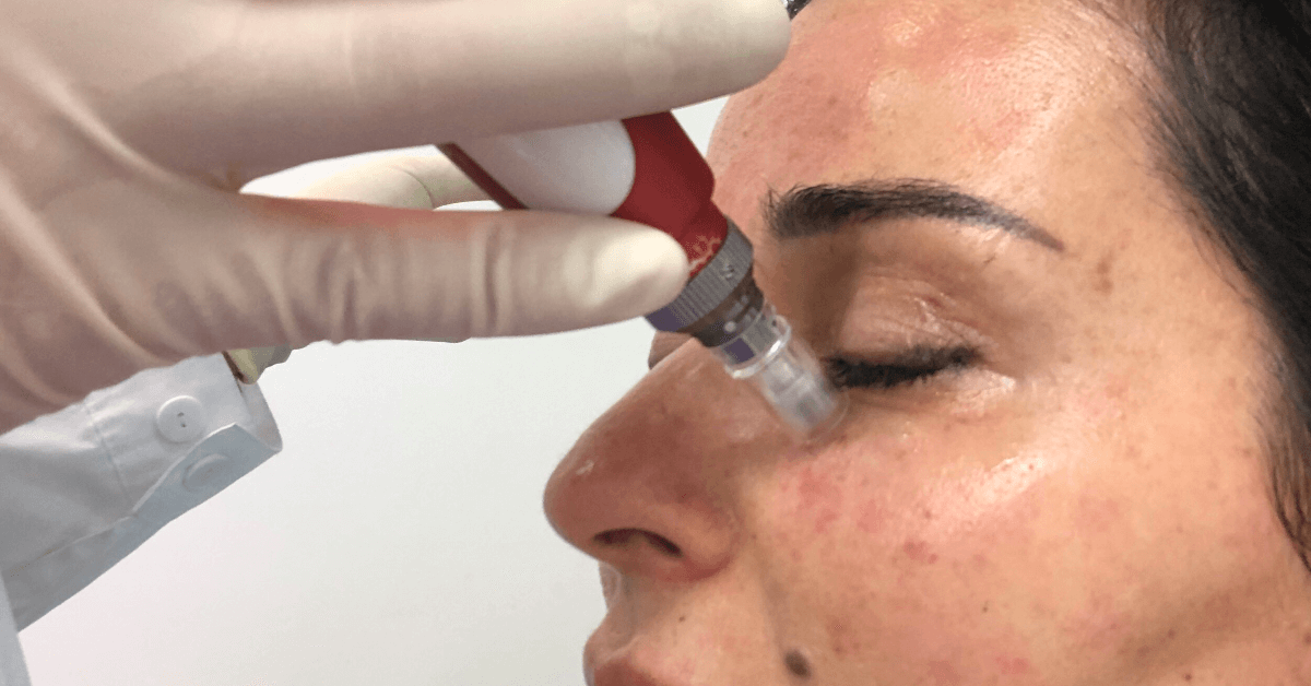 microneedling face treatments near Orlando