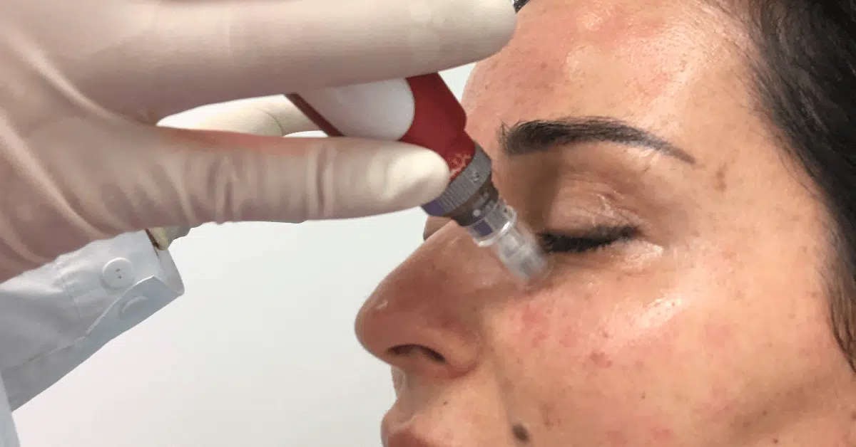 microneedling face treatments near Orlando microneedling face treatments near Orlando