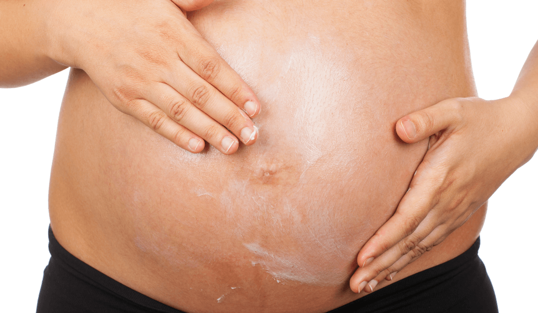 Reducing Stretch Mark Scars Is Easier Than You Think