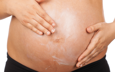 Reducing Stretch Mark Scars Is Easier Than You Think