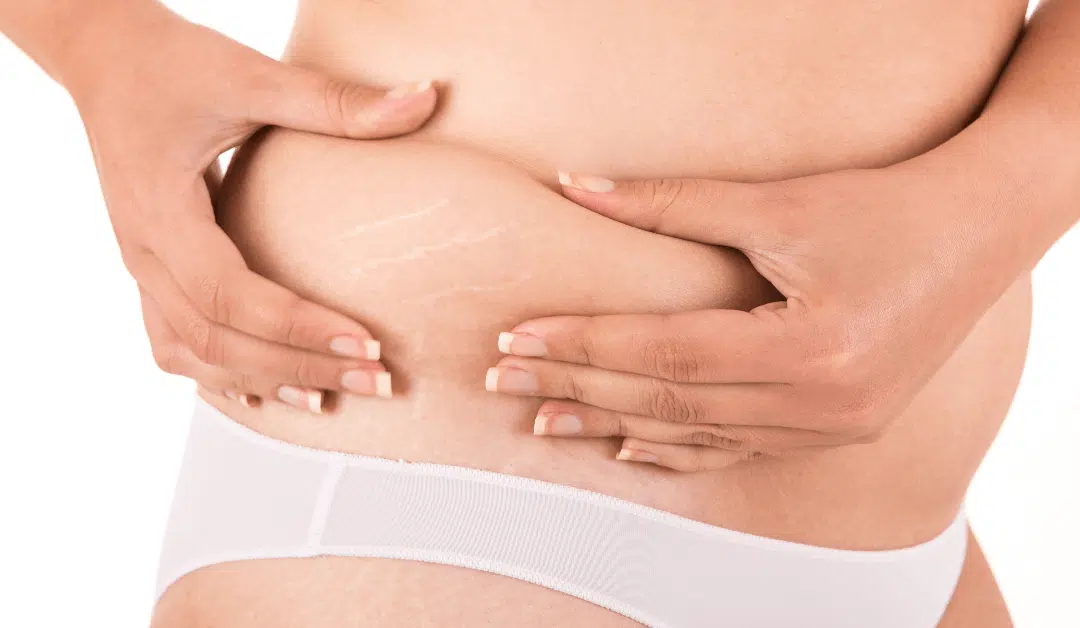Stretch Mark Removal: Bring Brand New Skin Into The New Year
