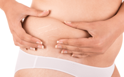 Stretch Mark Removal: Bring Brand New Skin Into The New Year