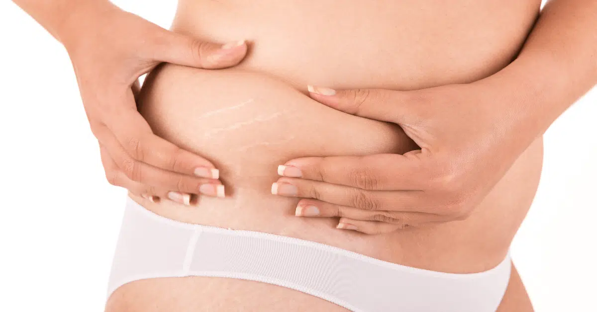 stretch mark removal in Orlando