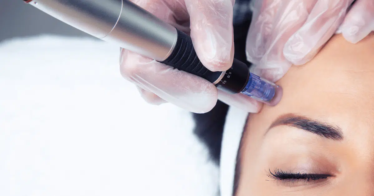 microneedling skin resurfacing in orlando winter park