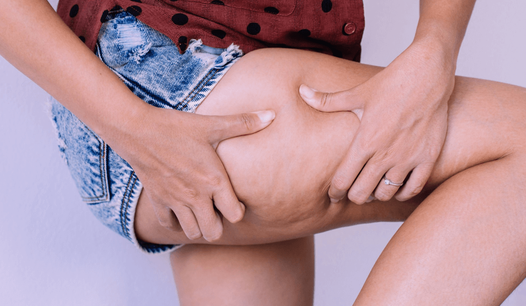 Cellulite Treatment & Everything You Need to Know