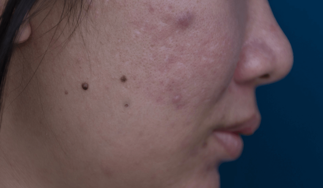 What Causes Black Spots On The Face And How To Get Ri vrogue.co