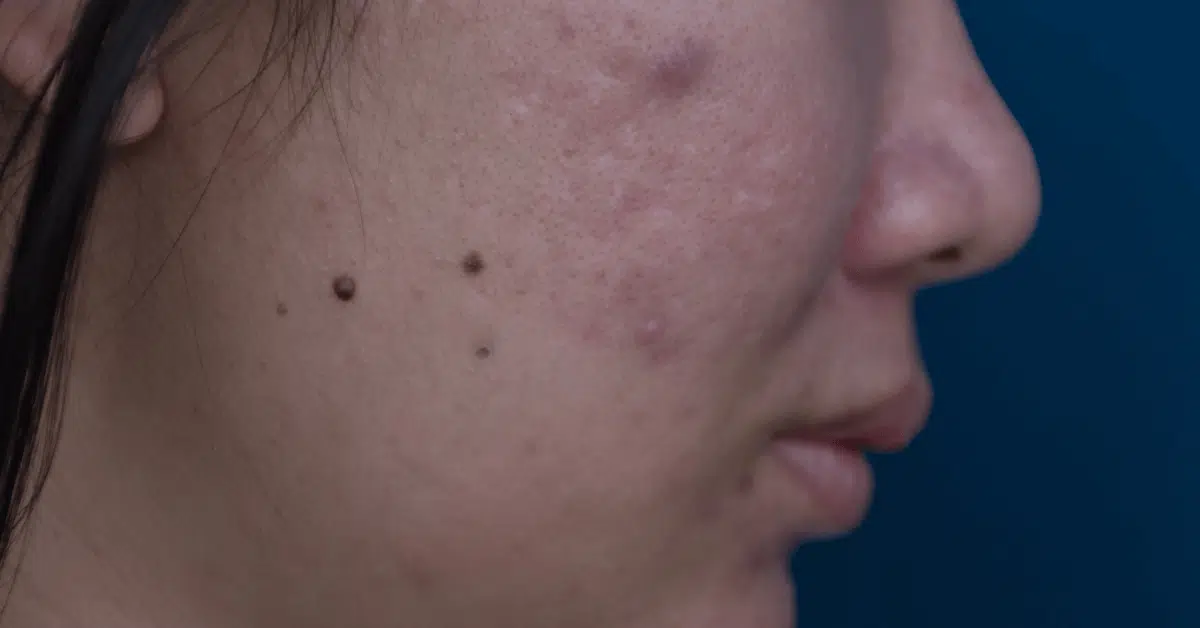 remove dark spots on face in Orlando Winter Park