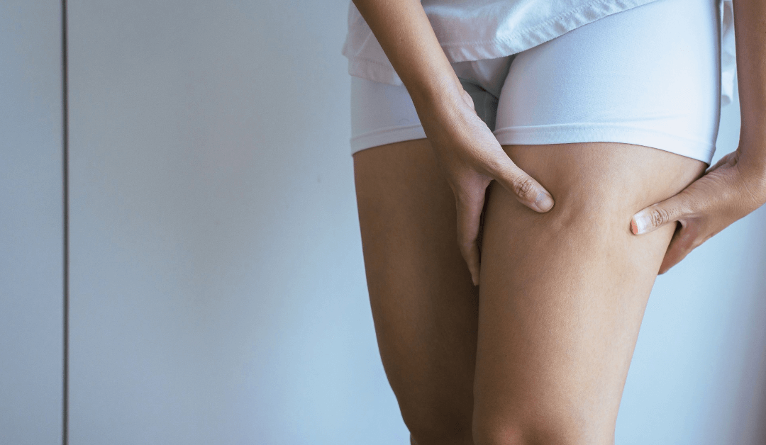 Cellulite treatment at Wymore Laser in Winter Park Orlando