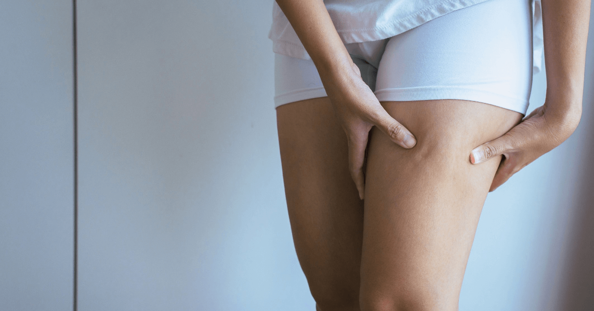 Cellulite treatment at Wymore Laser in Winter Park Orlando