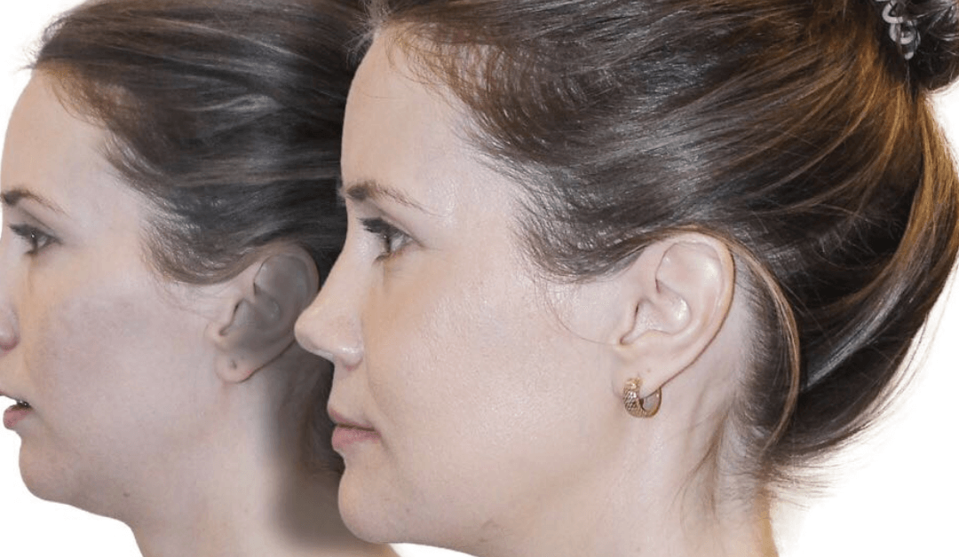 Is Non Surgical Jawline Contouring Right For You?