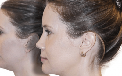 Is Non Surgical Jawline Contouring Right For You?