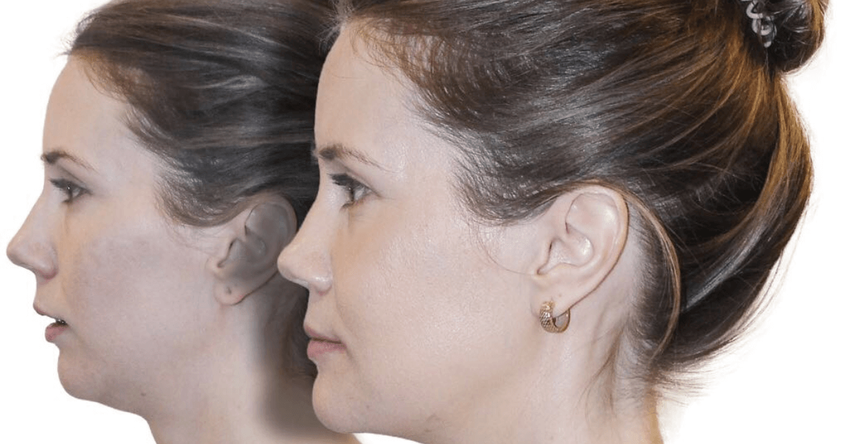 jawline contouring in Orlando and Winter Park Florida
