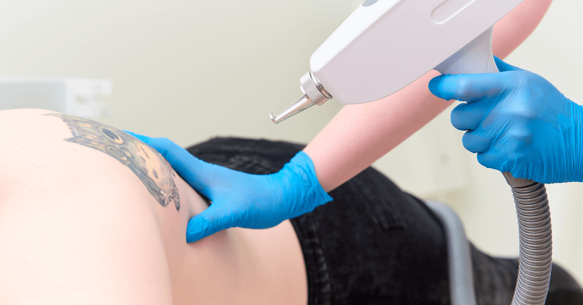Orlando laser tattoo removal
