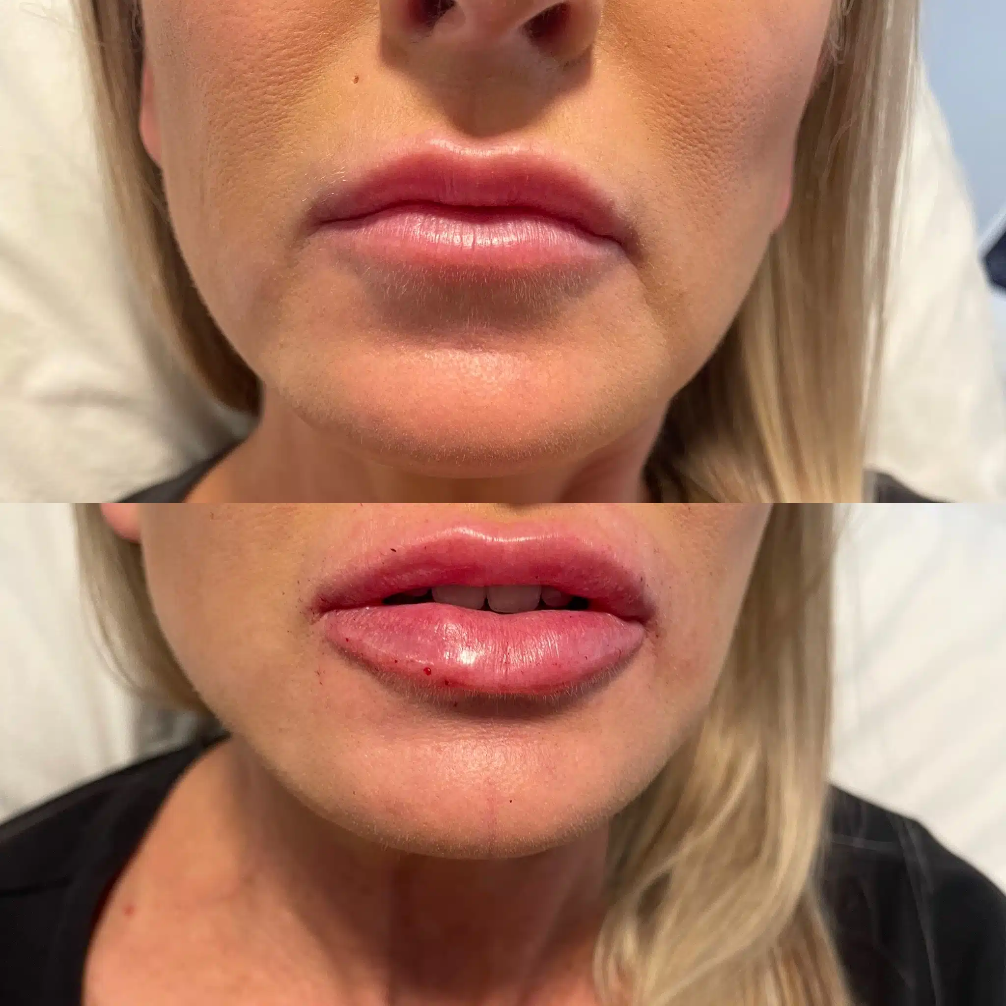 wymorelaser Botox near me