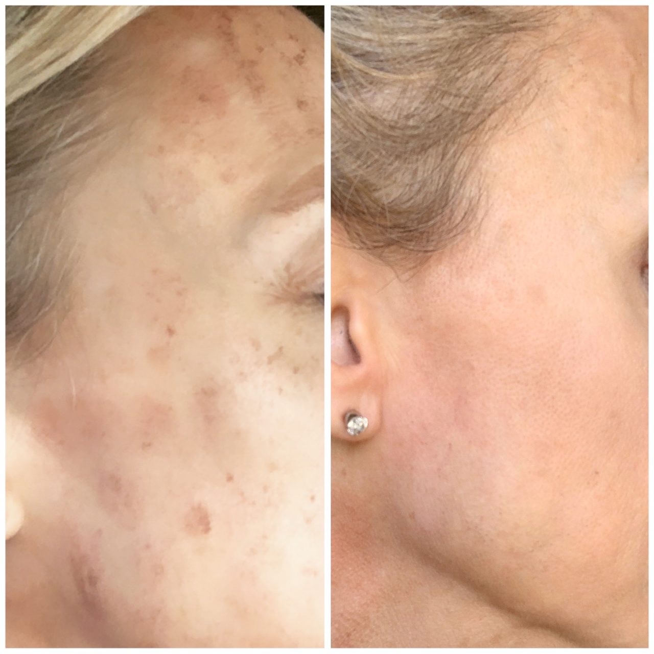Sun Damage & Redness near me Wymore Laser