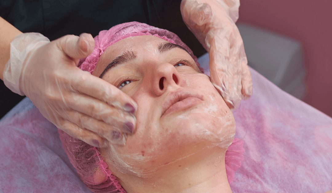 Chemical Peels: A Step Towards Your Dream Skin