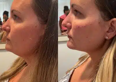 facial filler injections med spa winter park