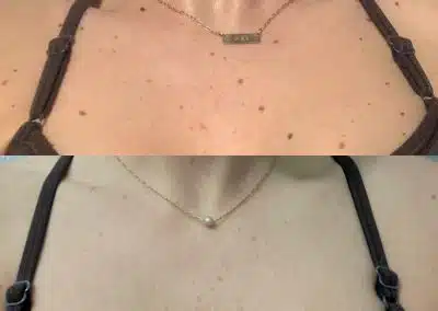 laser mole removal winter park