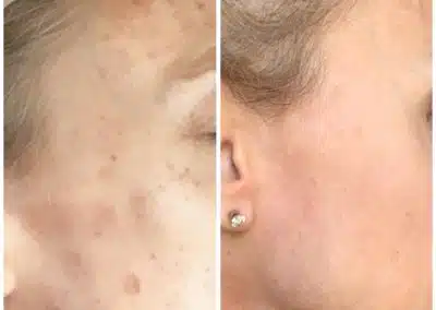 winter park anti aging laser treatment