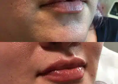 lip filler winter park florida