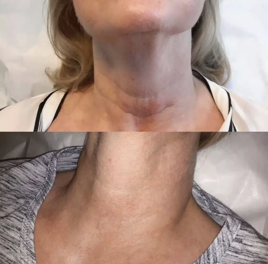 best micro needling treatment in Winter Park