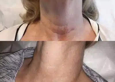 best micro needling treatment in Winter Park