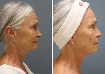 winter park anti aging microneedling