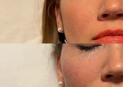 anti aging cheek filler winter park fl