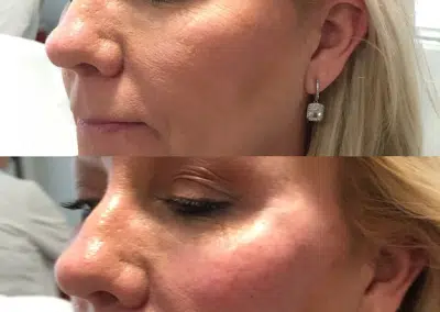 winter park med spa cheek filler