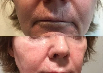 restylane winter park injections