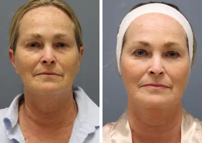 winter park microneedling med spa