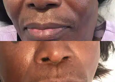 anti aging smile line injections