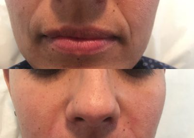 juvederm injections anti aging winter park