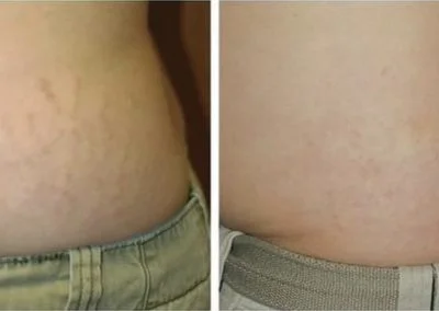 laser scar treatment stretch marks winter park florida