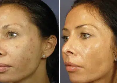 winter park anti aging chemical peel
