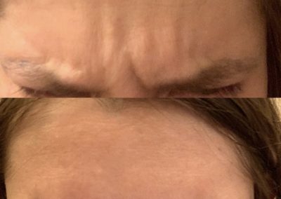 11 lines botox before and after