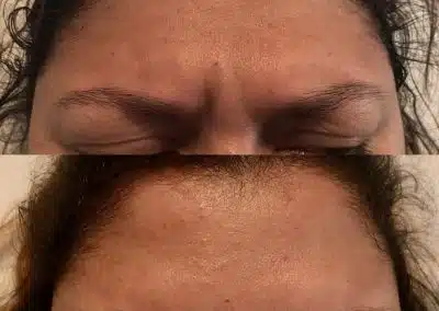 Dysport before and after | Browlift in Orlando
