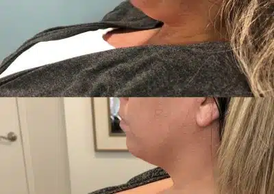 jaw contouring winter park fl