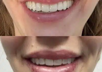 lip filler injections anti aging winter park