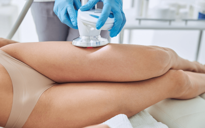 Laser Cellulite Treatment: What You Need to Know